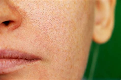 Acroma Melasma Laser Treatments In Oxford Lumiere Medispa Skin