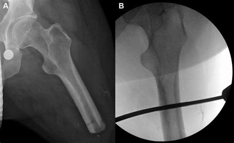 A Preoperative Anteroposterior Radiograph Of Surgical Left Hip And Download Scientific