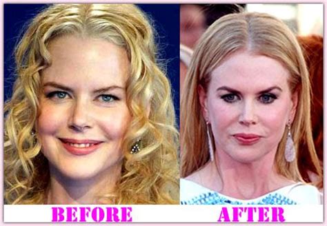 Nicole Kidman Plastic Surgery Botox Finally Revealed