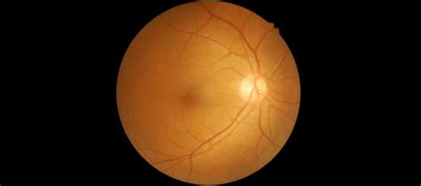 Retinal Nerve Fiber Bundle Damage Indicated By Reflectance Defects