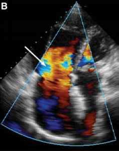 Mitral Valve Stenosis Area Lvot Echocardiography