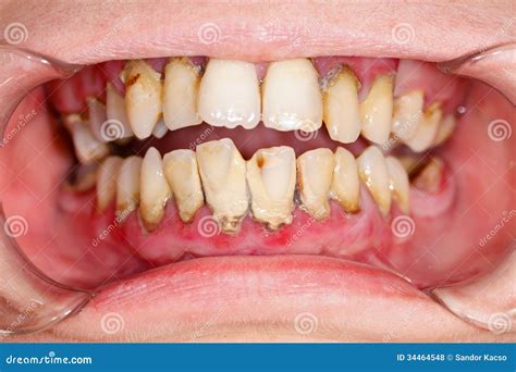 Tartar Stock Photo Image Of Gums Tooth Tartar Material