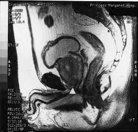 Magnetic Resonance Imaging Mri For Localization Of The Prostatic Apex Comparison To Computed