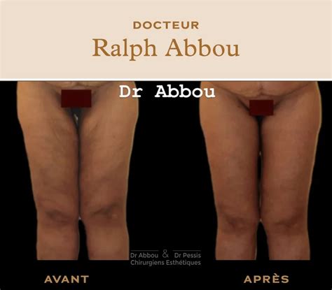 Avant Après Lifting des cuisses Dr Abbou