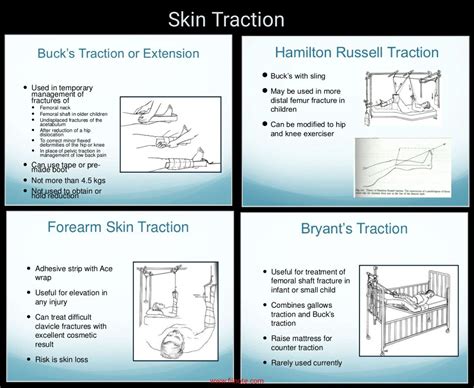 Skin Traction Vs Skeletal Traction Kailynbilnoble