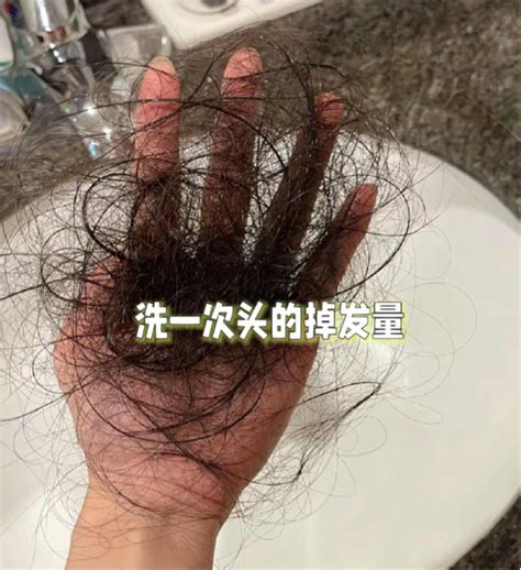 女生脱发严重怎么办？【配方师】教你4步防脱育发妙招！秃头女孩养出浓密秀发！ 知乎