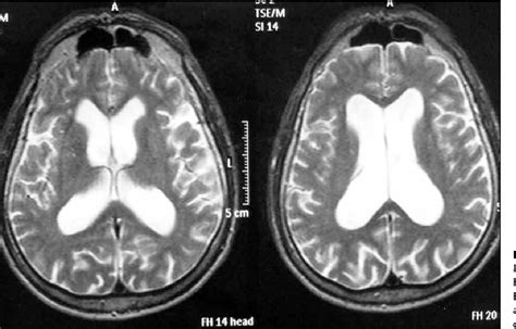 Figure From Emergency Management Of An Acute Tension Pneumocephalus