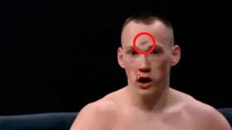 Kickboxer Danil Sharov Suffers Horrific Fractured Skull After Being