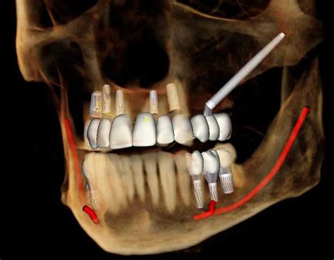 Zygomatic Implants The Anatomy Guided Approach