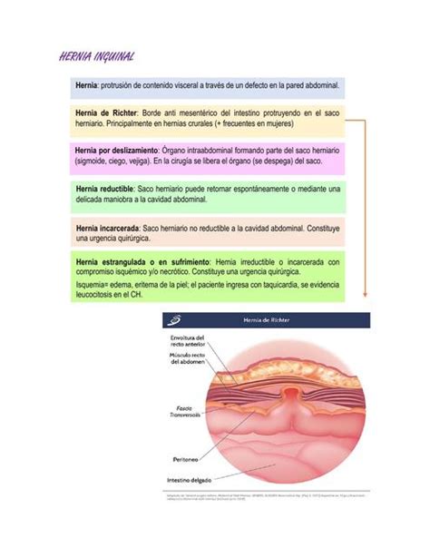 Resúmenes de Hernias inguinales Descarga apuntes de Hernias inguinales