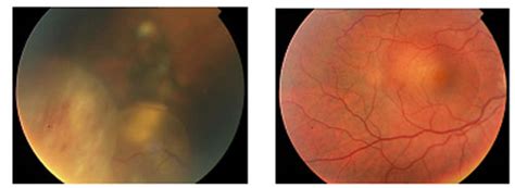 Retinoblastomas Sociedad Oftalmológica de la Comunidad Valenciana