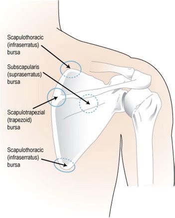 Technique And Outcomes Of Arthroscopic Scapulothoracic Bursectomy And