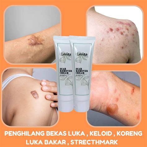 Lavine Scar Remover Obat Keloid Obat Keloid Di Telinga Keloid Menonjol