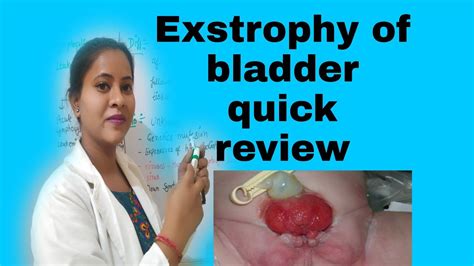 Exstrophy Of Bladder Causes Ss Management Surgical Management