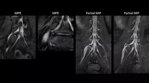 mri nerve visualization informs surgery philips