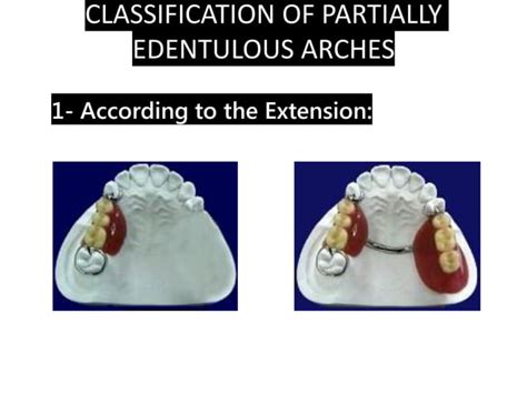 Removable Partial Denture 1. Introduction | PPT