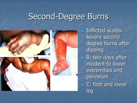 Ppt Dermatoses Resulting From Physical Factors Powerpoint