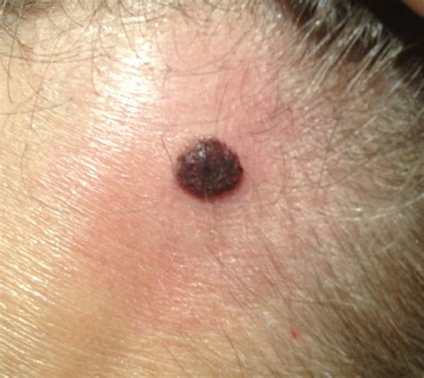 Photos Of Moles On Face And Neck ~ How To Remove Moles Warts Skin Tags Safely