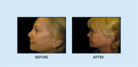 Facelift Before And After Dr Burt Greenberg Plastic Surgeon Located