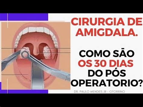 Cirurgia De Amigdala Como O Primeiro M S Do P S Operat Rio Youtube