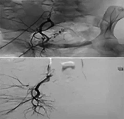 Successful Management Of Cesarean Scar Pregnancy In A Tertiary Care