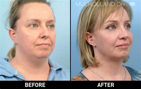 Cheek Lift Surgery Mid Facelift Toronto Plastic Surgeons