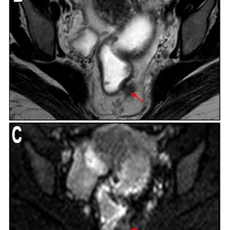 MRI For A 25 Year Old Male Patient With Pathologically Proven Rectal