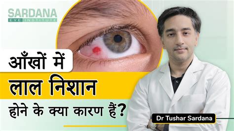 Causes Of Red Spot In Eye Aankho Me Khoon Aana Eye Specialist In