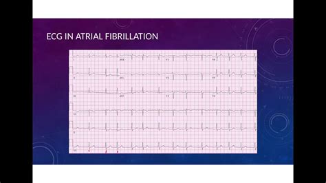 Atrial Fibrillation Youtube