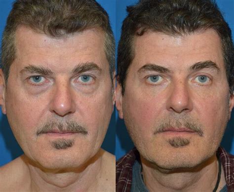 Seattle Man Gets Facial Surgery Telegraph