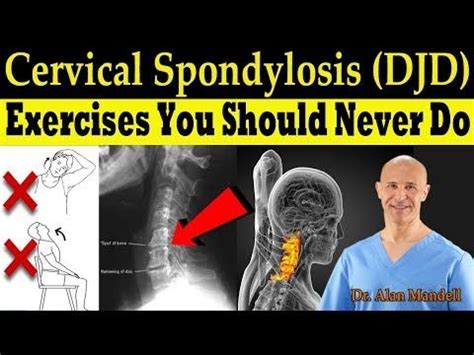 Cervical Spondylosis Djd Exercises You Should Never Do Correct