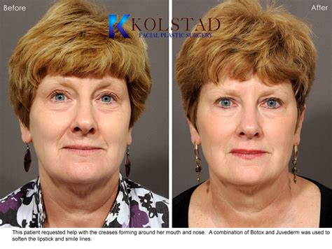 Combining Juvederm Botox To Correct Lipstick Lines Smile Lines