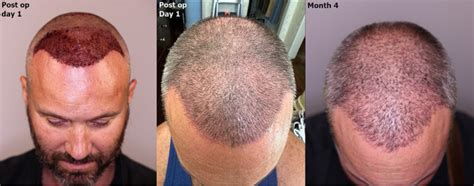 New 3 000 Graft FUE Hair Restoration Alvi Armani Hair Transplant