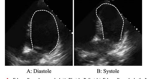 A Case Of Ventricular Fibrillation Induced By Takotsubo Syndrome With