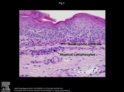 Romidepsin Induced Neutrophilic Urticaria Ppt Download