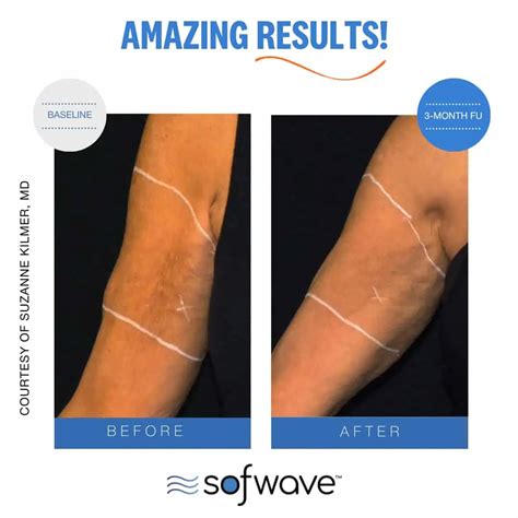 Sofwave™ Skin Tightening Treatments Miami Fl