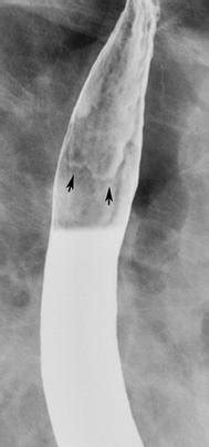 Barrett’s esophagus with an elevated Z line. Upright double-contrast... | Download Scientific ...