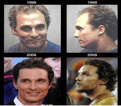 Matthew Mcconaughey Hair Transplant Plastic Surgery Hairline | Hair transplant, Celebrities male ...