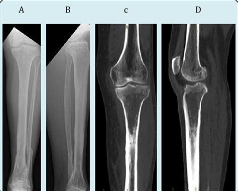 XR of healed tibial plafond fracture and CT at acute presentation A: AP ...