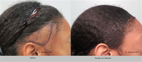 Women S Hair Transplant In Los Angeles