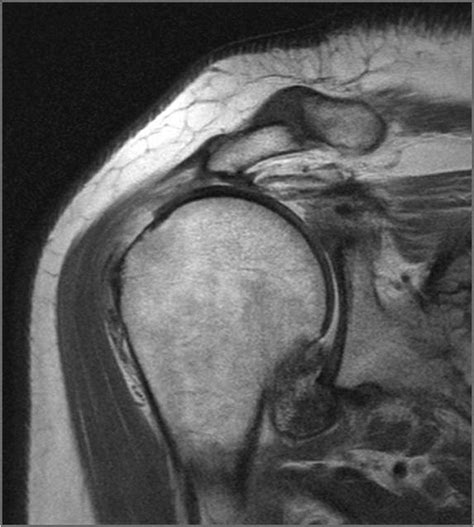 Rotator Cuff Tear