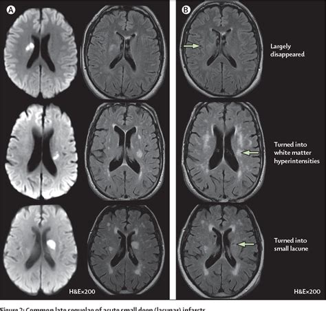 Figure From Mechanisms Of Sporadic Cerebral Small Vessel Disease