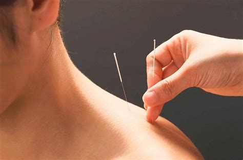 Acupuncture For Neck Pain How To Relieve Pain Naturally