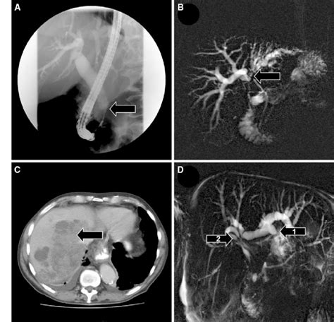 Clinical Examples Of Malignant Obstructive Jaundice A Ercp Image Download Scientific Diagram