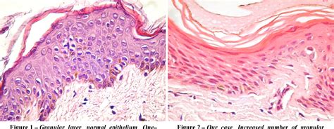 Figure From Atypical Variant Of Lichen Planus Mimicking Normal Skin