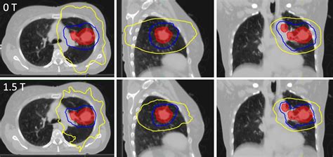 Treating Locally Advanced Lung Cancer With A 1 5T MR Linac Effects Of