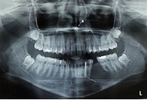 Orthopantamograph Showing A Well Defined Multilocular Radiolucency With