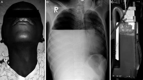 Pneumothorax In Liberia Complications Of Tuberculosis The Western