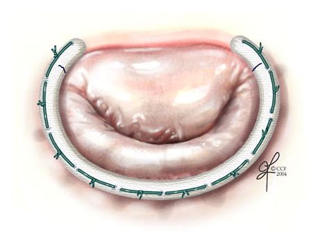 Mitral valve repair: A new choice