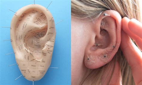 What Are Ear Seeds And How Do They Work